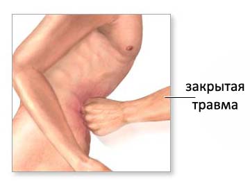 Закрытая травма живота