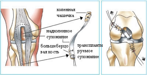 Замена связки коленного сустава