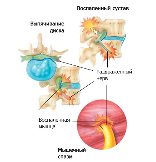 Защемление нерва при грыже позвоночника