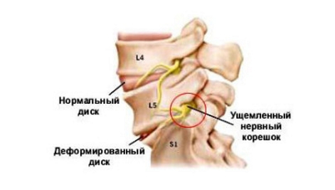 Защемление нерва шеи 