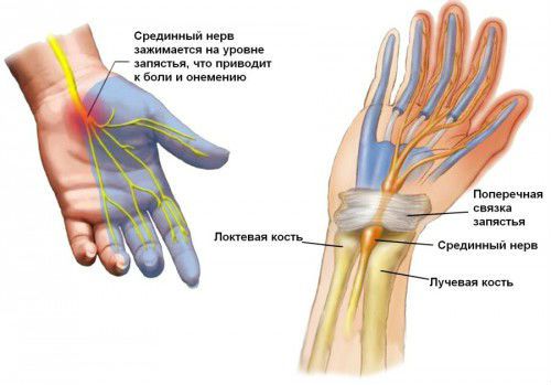 Защемление срединного нерва запястья