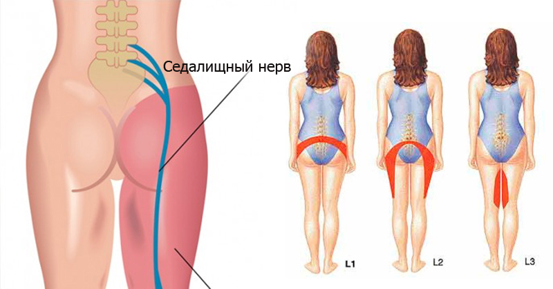 Распространение боли при неврите седалищного нерва